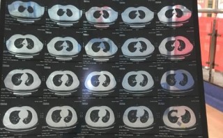 肺炎疫情隔离收费-疫情隔离费用是自费吗？