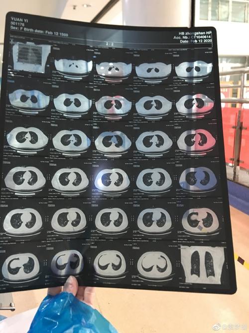 肺炎疫情隔离收费-疫情隔离费用是自费吗?-第1张图片-德宏生活网 肺炎疫情隔离收费-疫情隔离费用是自费吗?-第1张图片-德宏生活网