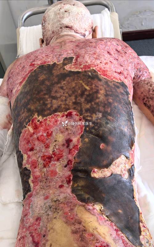 西班牙疫情超过-西班牙疫情超过中国了吗？-第5张图片-德宏生活网